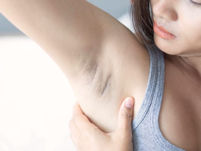 4 Tips for Underarm Care After Lymph Node Removal: Odor, Rash, and More