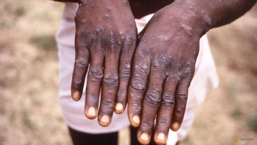 Britain offers smallpox shot as monkeypox cases spread in Europe