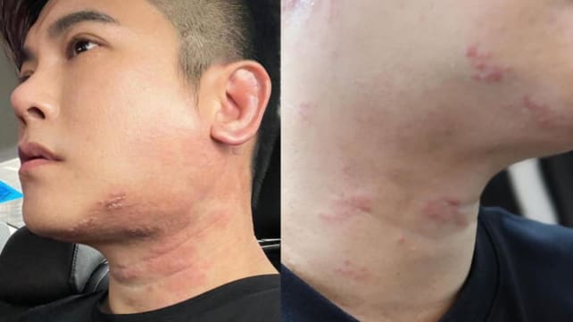 Actor Nick Shen reveals battle with shingles, consulted 'more than 10' specialists