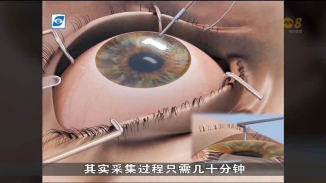 本地眼角膜移植手术逐年增加 去年创新高达620起