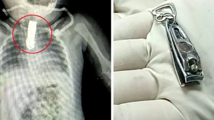  Kanak-kanak 8 bulan terpaksa jalani pembedahan gara-gara tertelan pengetip kuku 