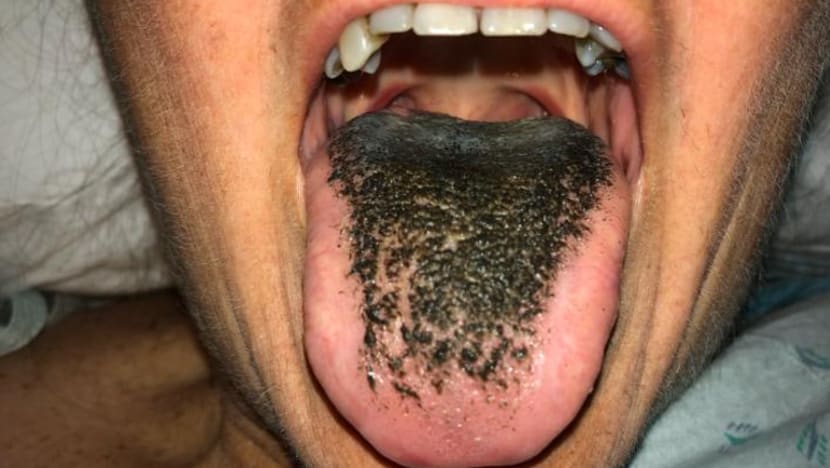 Apa sebenarnya 'rambut' hitam di lidah anda?