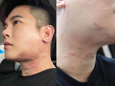 Actor Nick Shen reveals battle with shingles, consulted 'more than 10' specialists
