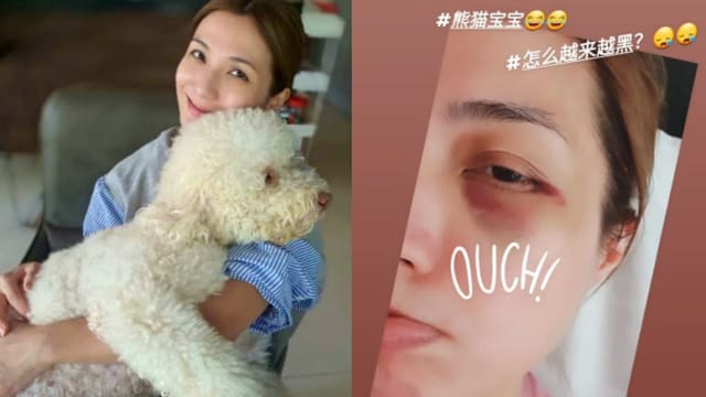 眼睛撞桌角血管破裂　赖怡伶晒“恐怖”照