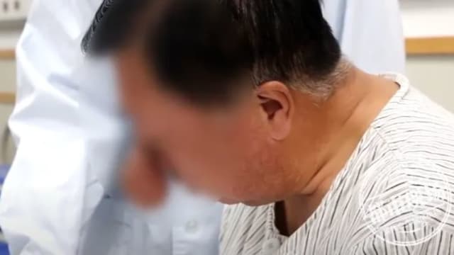 40年喝了上万斤酒 中国男子长出“象鼻”