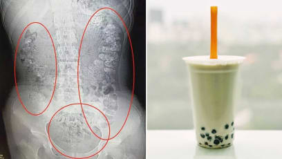 Girl’s Viral X-ray Shows Undigested Bubble Tea Pearls That Are Actually Impacted Faeces