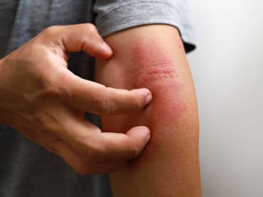 There’s a new eczema pill that offers quick and lasting relief – here’s what you need to know