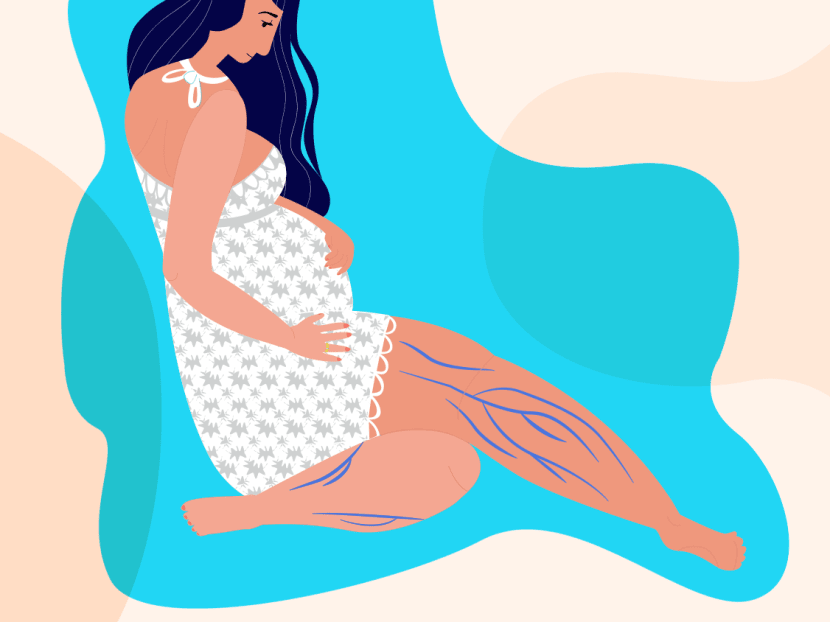 Varicose veins aren’t just unsightly but could also be a health risk – why do women still ignore them? Varicose veins aren’t just unsightly but could also be a health risk – why do women still ignore them?
