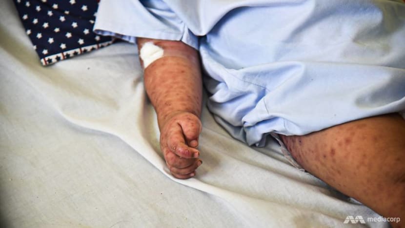 Measles cases in Singapore hit 149 amid global increase Measles cases in Singapore hit 149 amid global increase