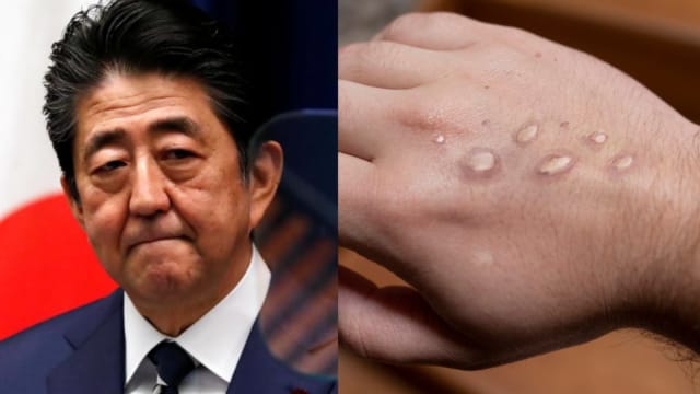 日本前首相安倍遇刺身亡 | 我国连续三天有人染猴痘