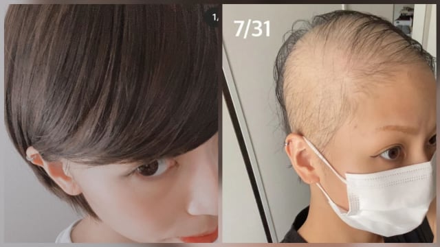 日本女子疑接种莫德纳疫苗后 严重脱发成秃头