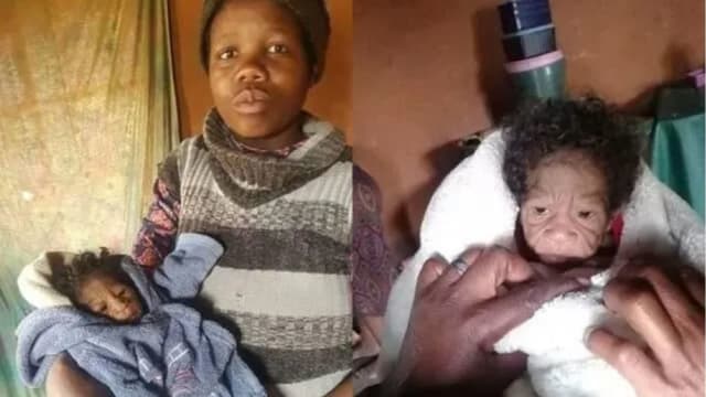 南非女婴患罕见早衰症 满脸皱纹比妈妈还老