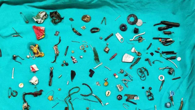随身储物柜？男子腹痛就医 胃里挖出60件家用品