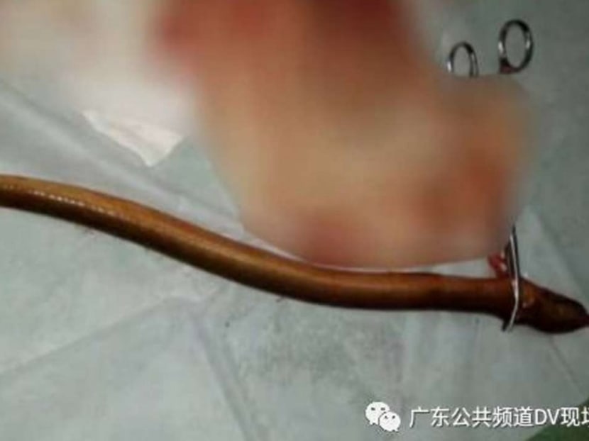 Doctors removed the live eel from the patient’s stomach. Photo: Handout via South China Morning Post