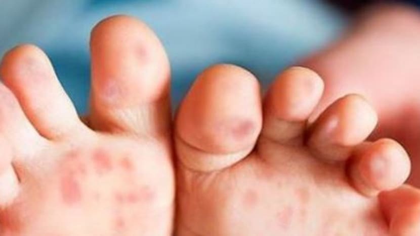 Kes HFMD M'sia naik 20 kali ganda, Selangor masih tertinggi Kes HFMD M'sia naik 20 kali ganda, Selangor masih tertinggi