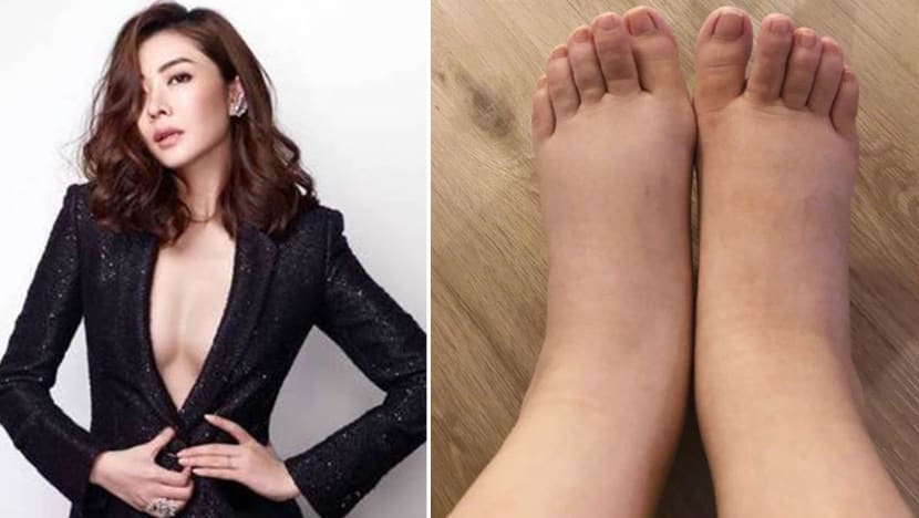 Lynn Hung shares photo of her swollen feet