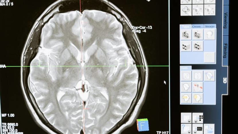 Commentary: Even mild cases of COVID-19 might be bad for our brains Commentary: Even mild cases of COVID-19 might be bad for our brains