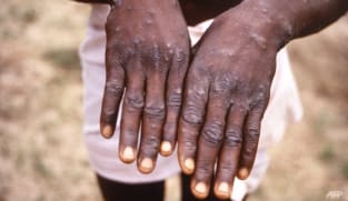 Commentary: Four ways the monkeypox outbreak can play out