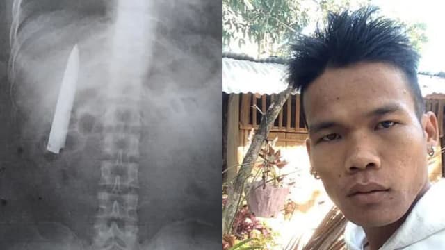 菲律宾男子遇袭15个月后才发现体内埋刀