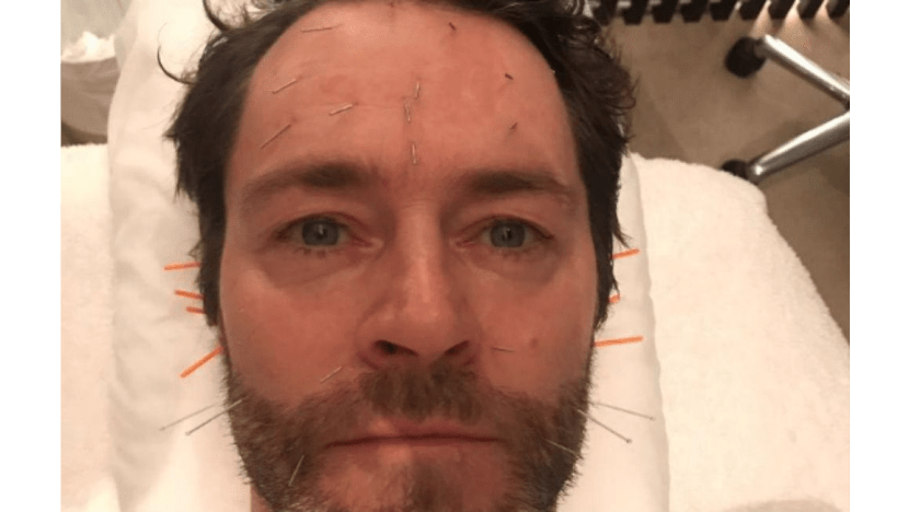 Howard Donald has acupuncture to cure binge eating
