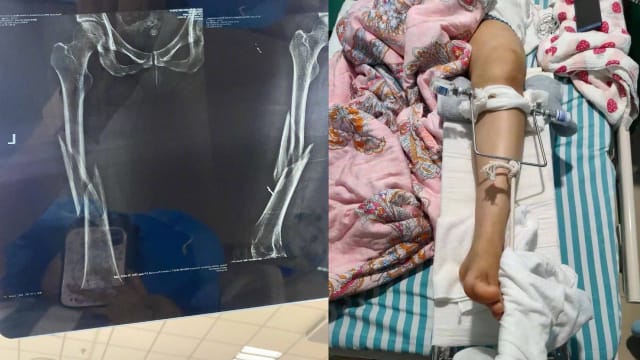 中国女子上瑜伽课 教练压腿竟造成粉碎性骨折