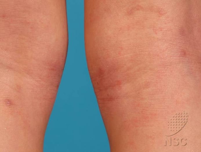 Tackling that itch Demand for help with skin issues on the rise in