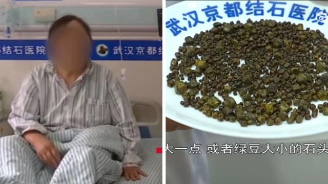 无肉不欢爱喝奶茶 中国妇女长出1350颗胆结石