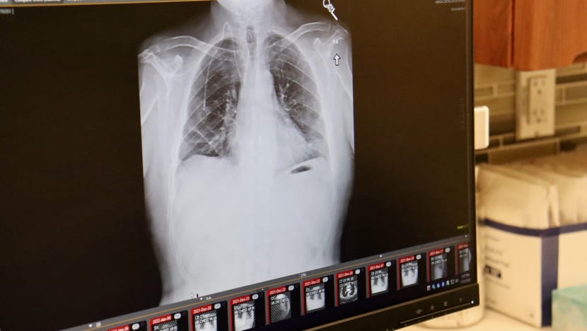 Doktor ini kongsi kisah lelaki yang meninggal dunia akibat rokok; paru-paru bernanah dan batuk berdarah Doktor ini kongsi kisah lelaki yang meninggal dunia akibat rokok; paru-paru bernanah dan batuk berdarah