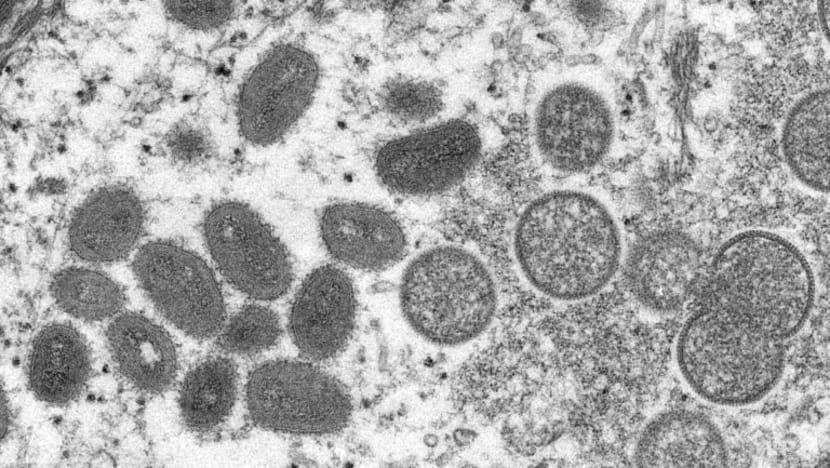 More than 700 monkeypox cases globally, 21 in US: CDC More than 700 monkeypox cases globally, 21 in US: CDC