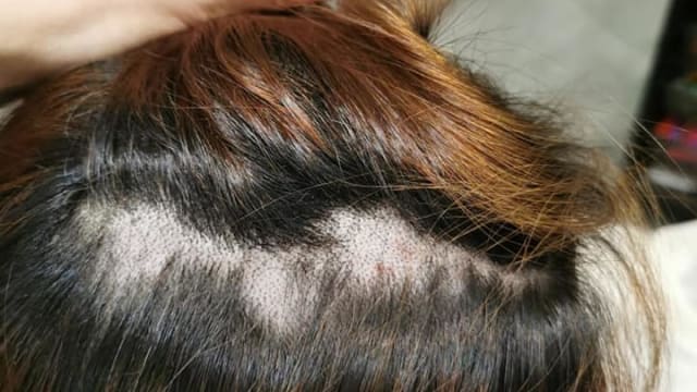 离子烫后大量掉发 女子头皮化学烧伤要半年才能“重生”
