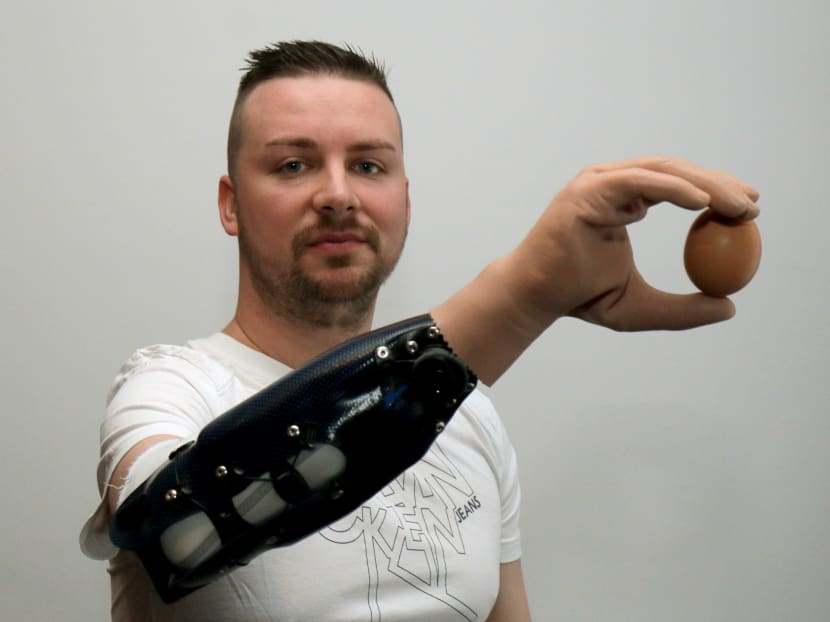 Mr Milorad Marinkovic holds an egg with his bionic arm from manufacturer Ottobock at home in Vienna, Austria, Tuesday, Feb. 24, 2015. Photo: AP