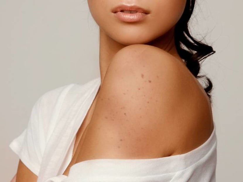 Are Asians really less prone to skin cancer? Or are we missing the early signs? Are Asians really less prone to skin cancer? Or are we missing the early signs?