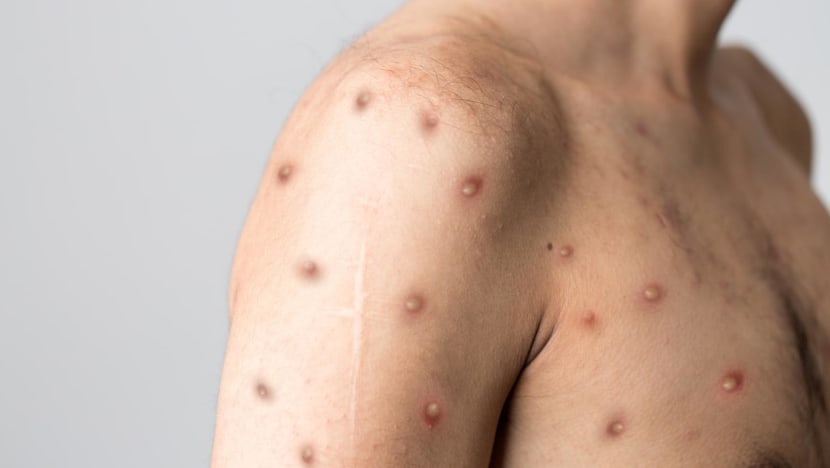 Singapore confirms one more imported case of monkeypox infection Singapore confirms one more imported case of monkeypox infection