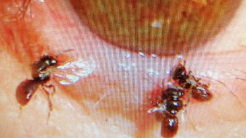 Eye'll bee damned: Taiwanese woman finds insects in eye