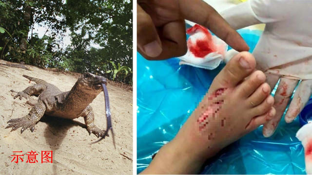 巨蜥闯刁曼岛度假村 三岁男童脚被咬伤缝30针 