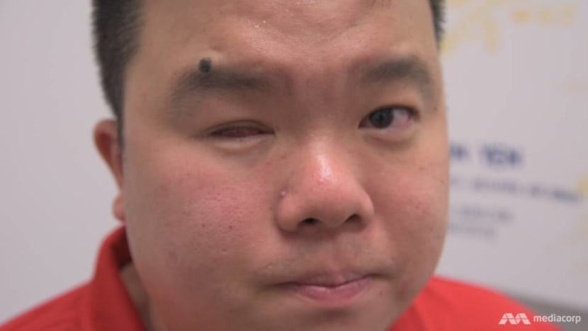 Jason Chee, medal-winning para-athlete, loses right eye to cancer Jason Chee, medal-winning para-athlete, loses right eye to cancer