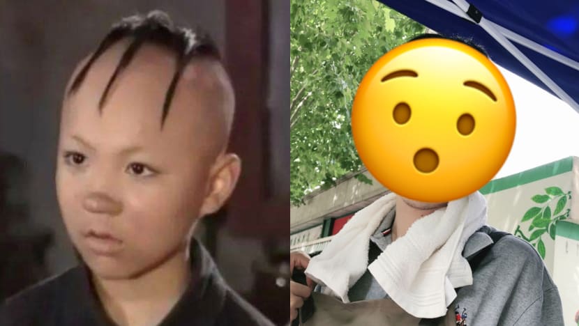 Former Child Star Needed Hair Transplant Surgery After Shaving His Head Many Times As A Kid; This Is What He Looks Like Now