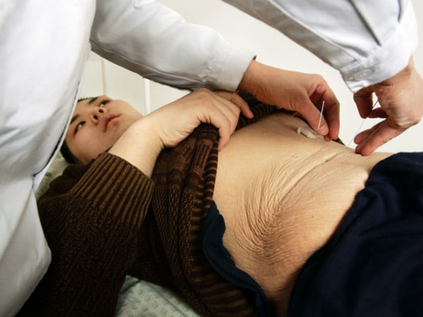 TCM treatments such as acupuncture are proving effective in helping people to lose weight. Photo: REUTERS