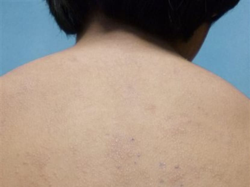 This photo shows a rash on an unidentified 11-year old boy from a nickel allergy. Photo: American Academy of Pediatrics/AP