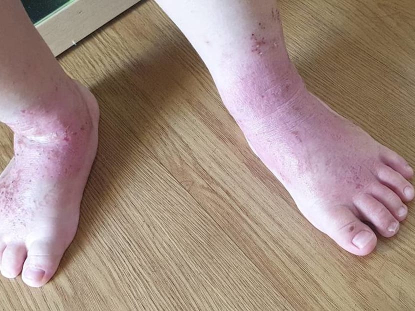 Infant eczema: Genes play a role but symptoms can be controlled, doctors say Infant eczema: Genes play a role but symptoms can be controlled, doctors say