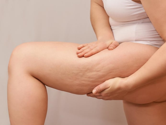 The truth about cellulite: What is it, why do we get it and what can we do about it? - CNA Lifestyle