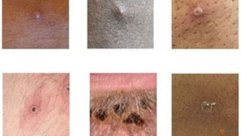 Monkeypox symptoms differ from previous outbreaks: UK study Monkeypox symptoms differ from previous outbreaks: UK study