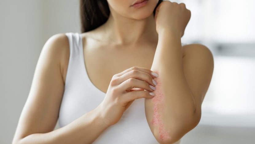 HERO Psoriasis