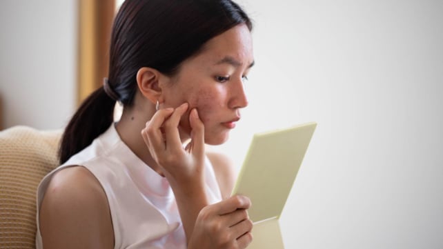 Not all marks left by pimples are scars – how to tell the difference and why they should be treated differently