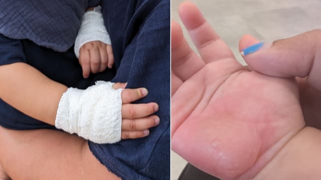 11个月大幼儿双手灼伤 母亲控诉托管中心疏忽