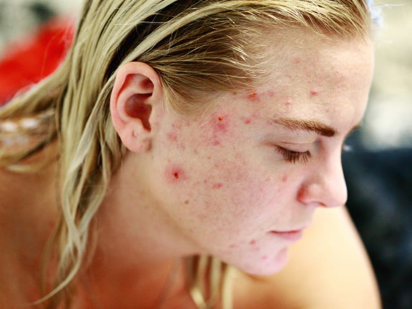 Adult acne can have a number of causes, but there are ways to treat it.