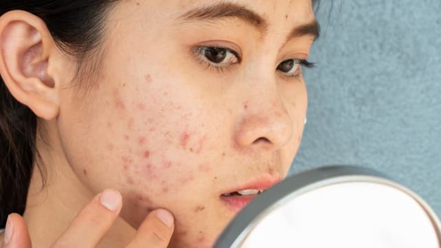 Here’s why misusing acne medications might make your body resistant to antibiotics 