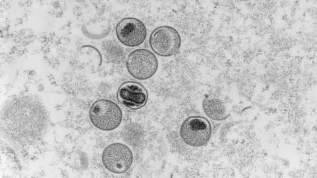 猴痘全球迅速传播 世卫正研究是否同病毒变异有关