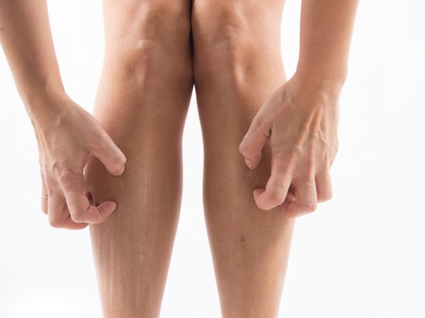 You’re running and your legs suddenly develop a bad case of itchy rashes – what’s the reason for that?