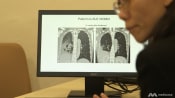 Better Odds in Fighting Lung Cancer